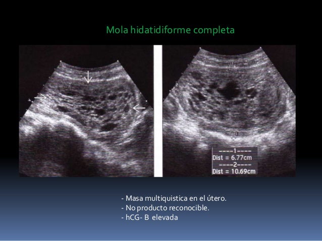 gestacion anembrionada